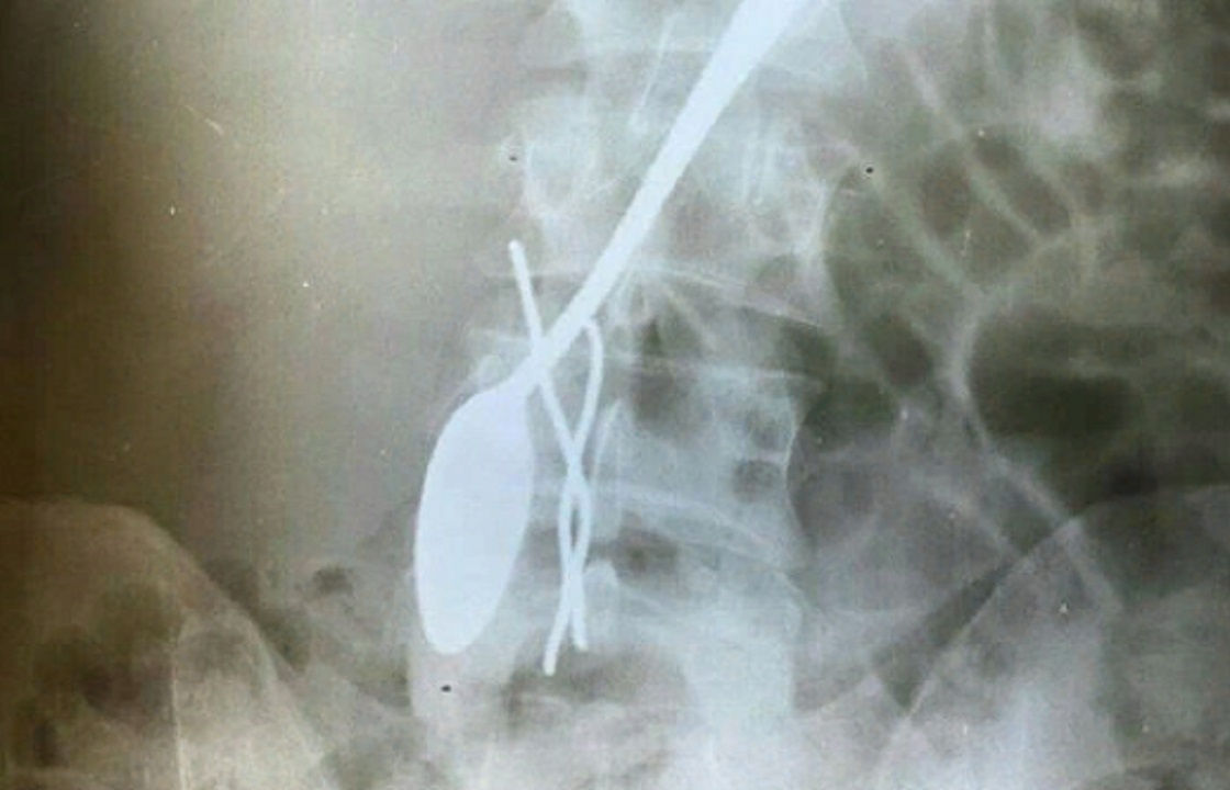 Хирурги достали из живота жителя Махачкалы ложку. Фото