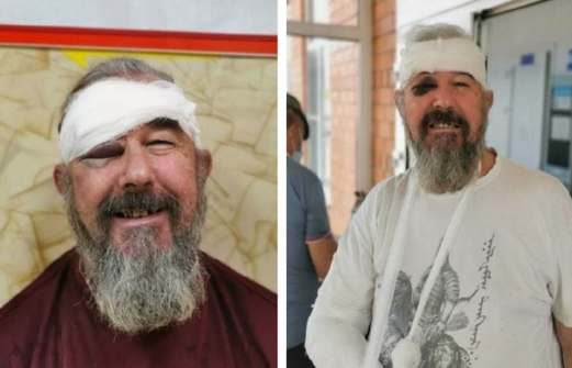 Пенсионер на Кубани заявил, что полицейские сломали ему руку за отказ надеть маску